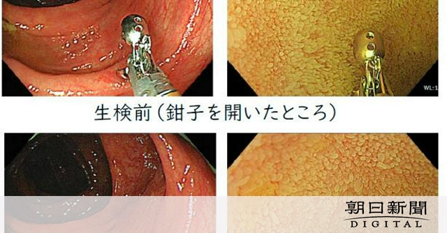 大腸がんの進行と、一見正常な小腸が関係する可能性　大阪大